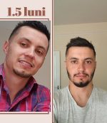 Minoxidil Kirkland 5% + Zinc Picolinate, 50 mg, Now, 60 Capsule + Biotin 1000 mcg, 100 Capsule,Tratament pentru caderea parului si cresterea barbii - imagine 2