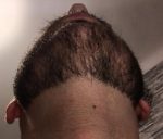 Minoxidil Rogaine 5%, 1 Luna Aplicare, Tratament pentru caderea parului si cresterea barbii - imagine 9