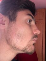 Minoxidil Foligain 5%, 1 Luna Aplicare, Tratament pentru caderea parului si cresterea barbii, Cantitate de Alcool Redusa, 60 ml - imagine 5