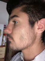 Minoxidil Foligain 5%, 1 Luna Aplicare, Tratament pentru caderea parului si cresterea barbii, Cantitate de Alcool Redusa, 60 ml - imagine 6