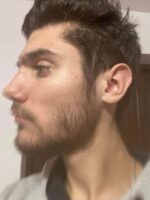 Minoxidil Foligain 5%, 1 Luna Aplicare, Tratament pentru caderea parului si cresterea barbii, Cantitate de Alcool Redusa, 60 ml - imagine 8