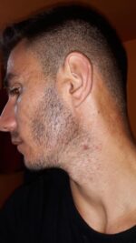 Rogaine 5% Minoxidil Spuma, 1 Luna Aplicare, Tratament pentru caderea parului si cresterea barbii, 60 ml - imagine 5