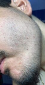 Minoxidil Regaine Spuma 5%, 1 Luna Aplicare, Tratament pentru caderea parului si cresterea barbii - imagine 3
