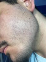 Minoxidil Regaine Spuma 5%, 1 Luna Aplicare, Tratament pentru caderea parului si cresterea barbii - imagine 4