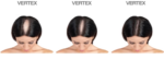 Spuma - Minoxidil Foligain 2%, 3 Luni Aplicare, Tratament Pentru Scalp, Femei - imagine 4