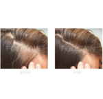 Spuma Pentru Regenerarea Parului FOLIGAIN Minoxidil 2% Pentru Femei, Tratament pentru 1 Luna - imagine 4