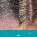 Sampon Exfoliant Antimatreata – Tratament Dermatologic Impotriva Dermatitei Seboreice, Psoriazisului si Matretii Cronice, cu Acid Salicilic 2%, Carbune Activ si Ingrediente Clinice pentru Calmarea Scalpului, Reducerea Pruritului si Descumarii, Formula Imbunatatita pentru Utilizare Zilnica, 205 ml, DS LABS Dandrene - imagine 8