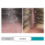 Balsam Exfoliant Antimatreata – Tratament Dermatologic Complementar Impotriva Dermatitei Seboreice, Psoriazisului si Matretii Cronice, cu Aloe Vera, Complex de Cheratina si Ingrediente Active Clinice pentru Hidratarea Scalpului, Reducerea Pruritului si Regenerarea Firului de Par, Formula Intensiva pentru Utilizare Zilnica, 205 ml, DS LABS Dandrene - imagine 7