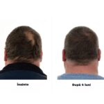 FOLIGAIN Formula Completa cu Actiune Tripla pentru Par cu Tendinta de Rarire la Barbati – 10% TRIOXIDIL - imagine 8